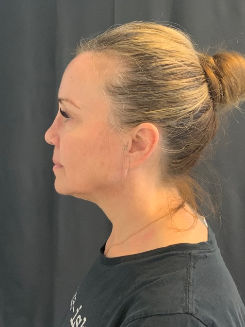 Preservation Facelift Before & After Image