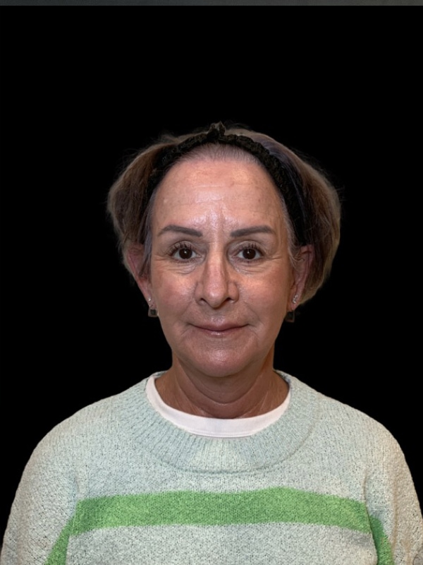 Preservation Facelift Before & After Image