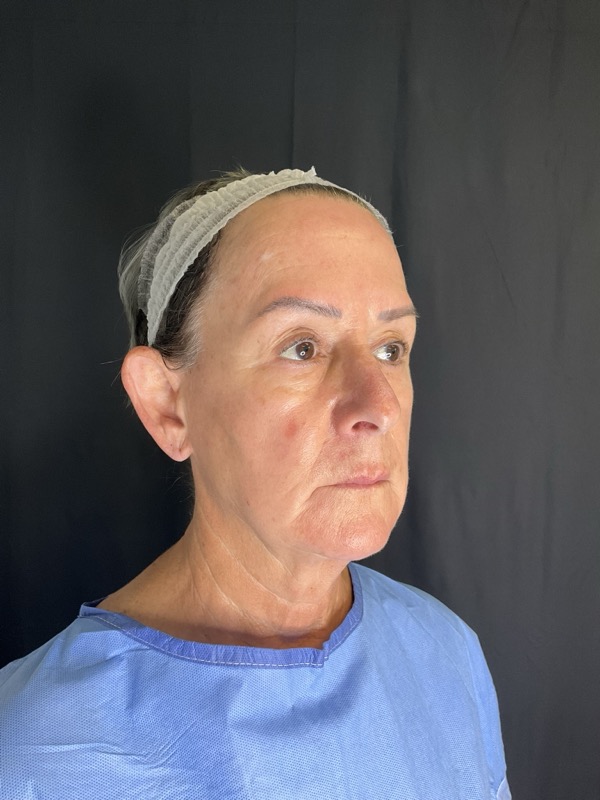 Preservation Facelift Before & After Image