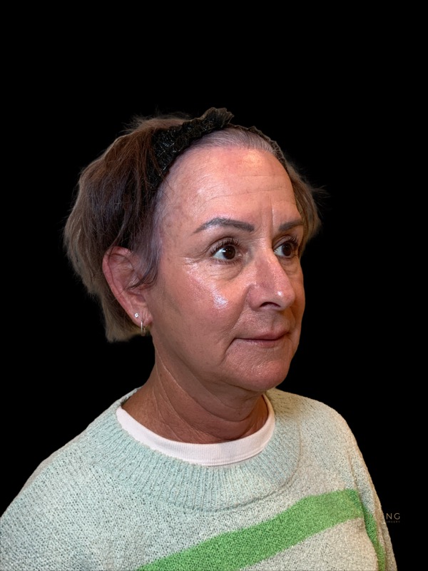 Preservation Facelift Before & After Image