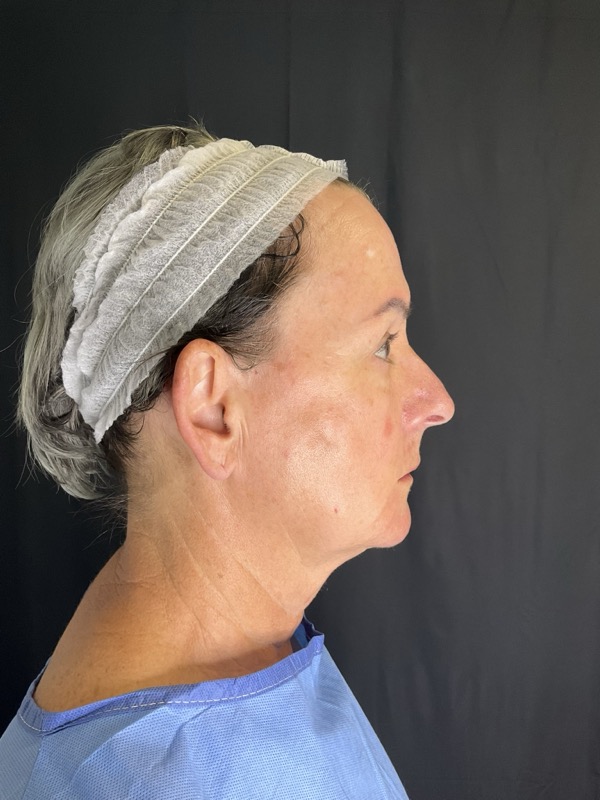 Preservation Facelift Before & After Image