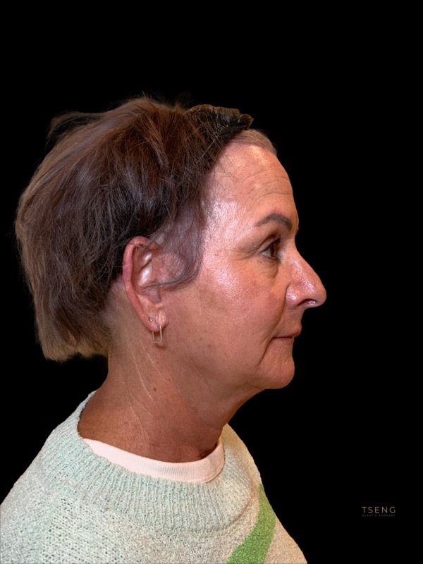 Preservation Facelift Before & After Image