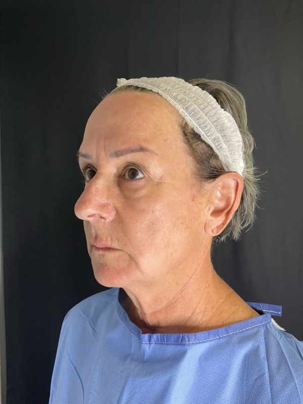 Preservation Facelift Before & After Image
