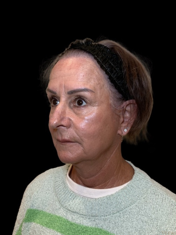 Preservation Facelift Before & After Image