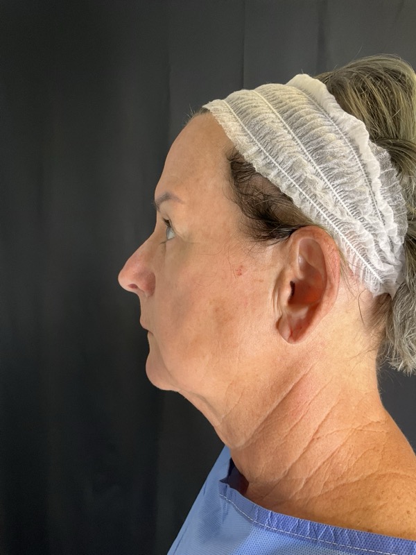 Preservation Facelift Before & After Image