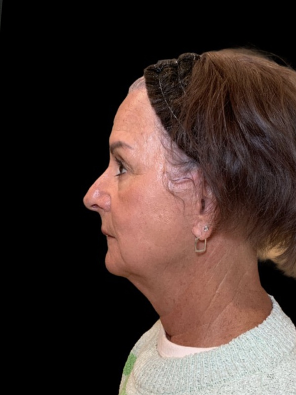 Preservation Facelift Before & After Image