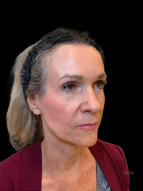 Preservation Facelift Before & After Image