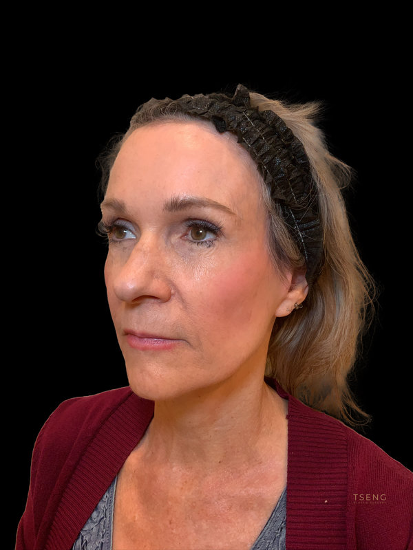 Preservation Facelift Before & After Image