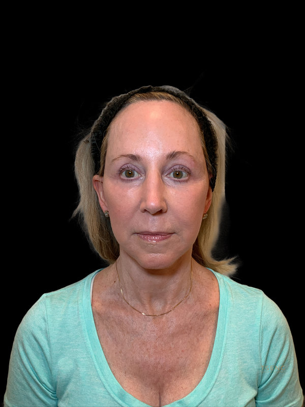 Preservation Facelift Before & After Image