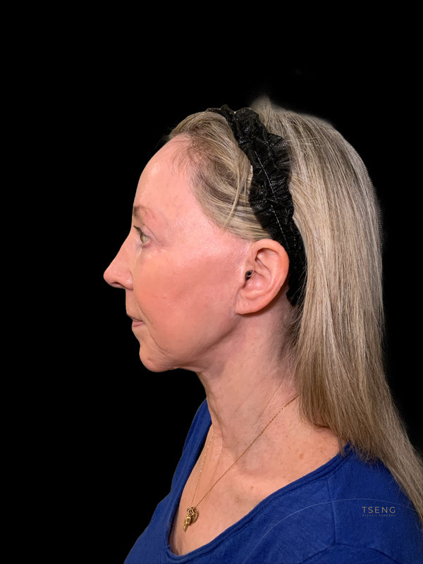 Preservation Facelift Before & After Image