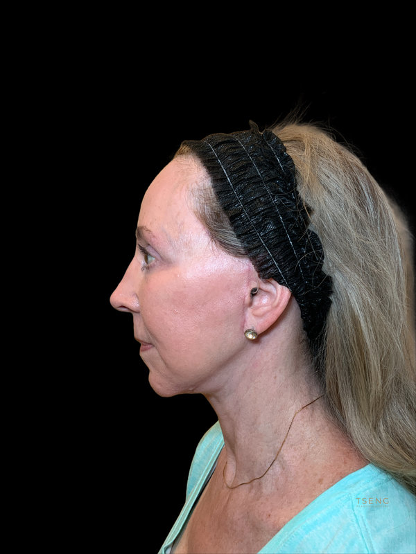 Preservation Facelift Before & After Image