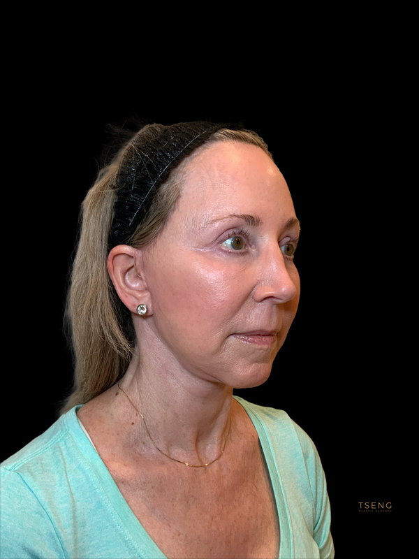 Preservation Facelift Before & After Image