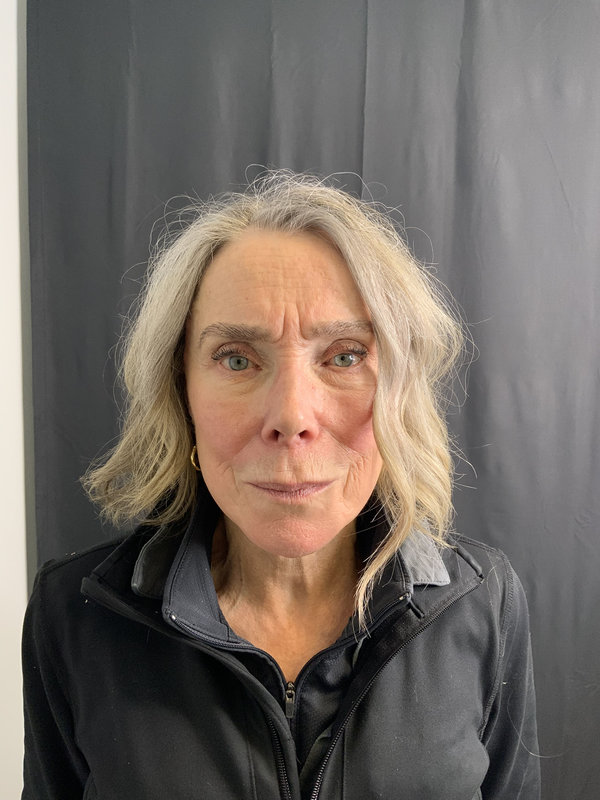 Preservation Facelift Before & After Image