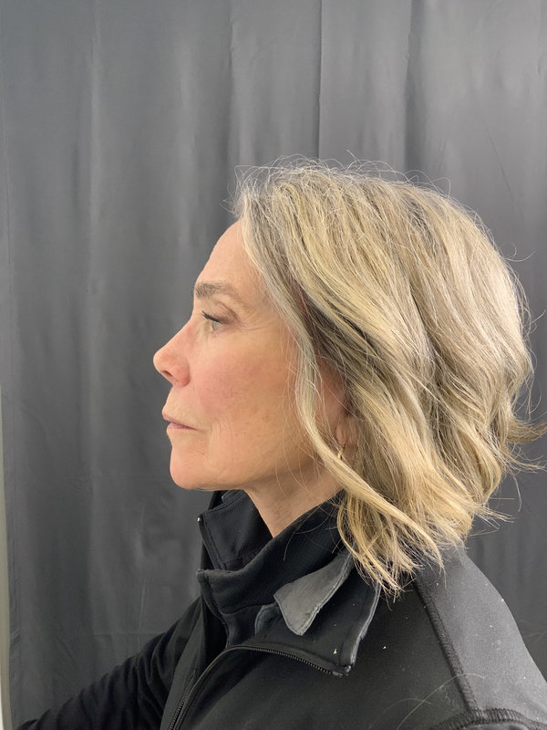 Preservation Facelift Before & After Image