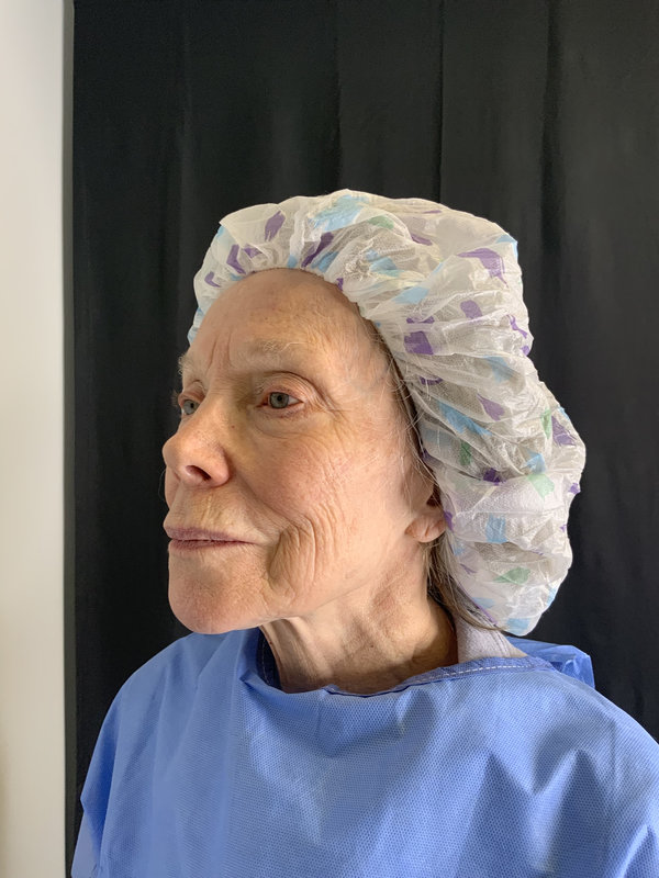 Preservation Facelift Before & After Image