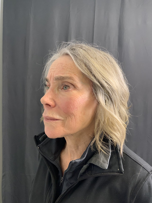 Preservation Facelift Before & After Image