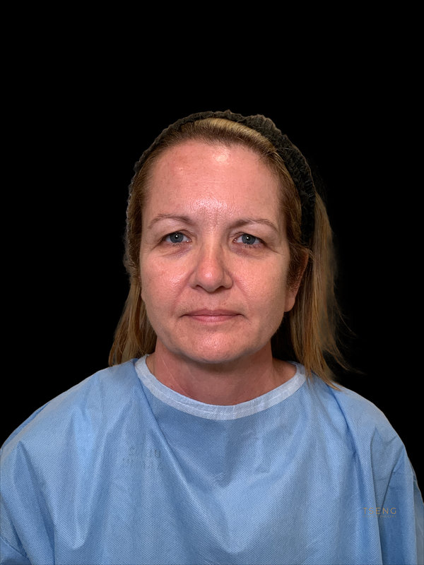 Preservation Facelift Before & After Image