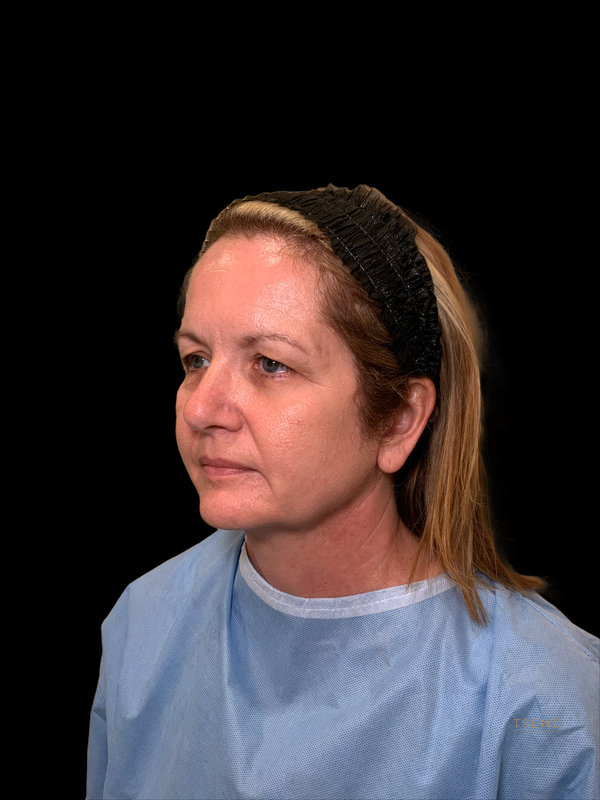 Preservation Facelift Before & After Image