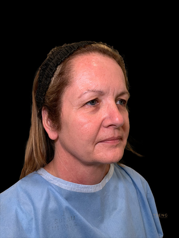 Preservation Facelift Before & After Image
