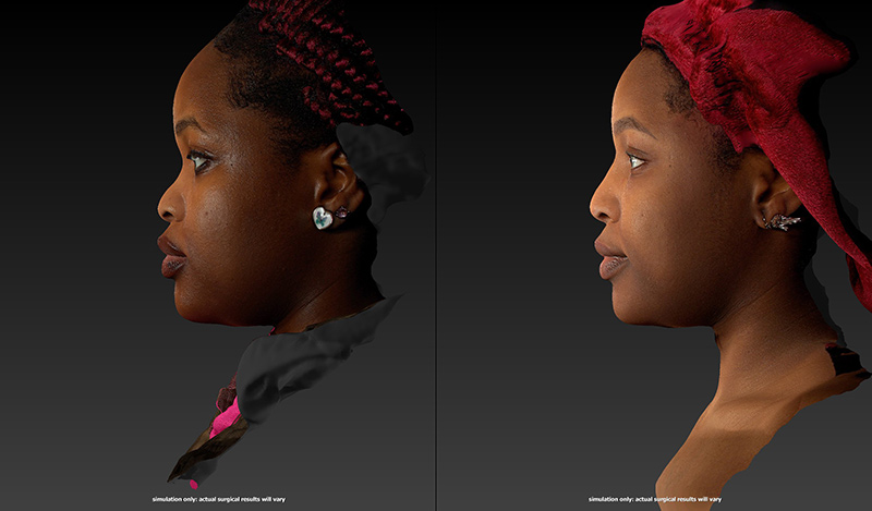 Renuvion Before & After Image