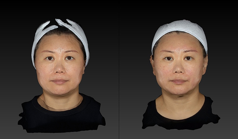 Renuvion Before & After Image