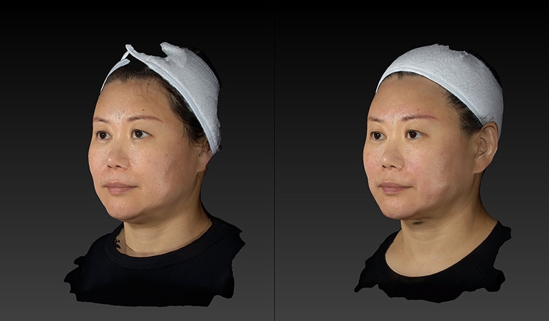 Renuvion Before & After Image