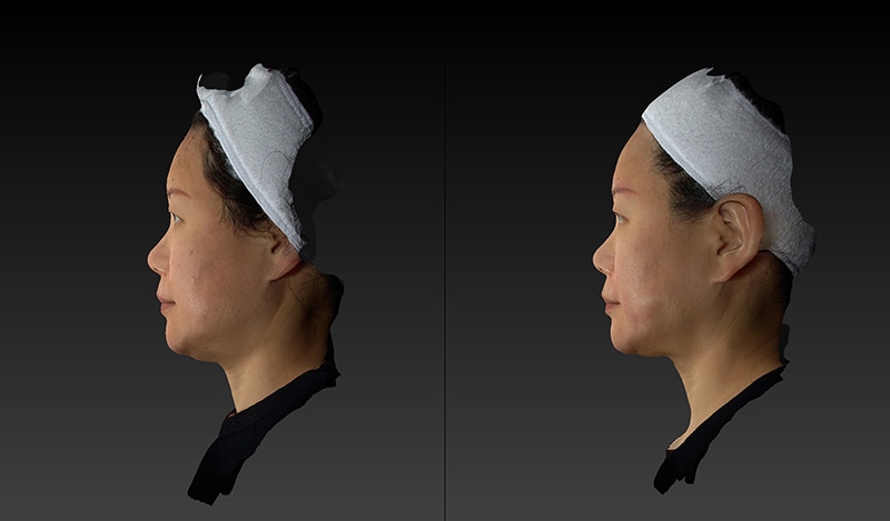 Renuvion Before & After Image