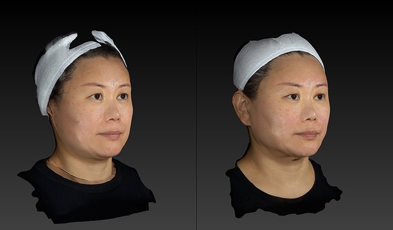Renuvion Before & After Image