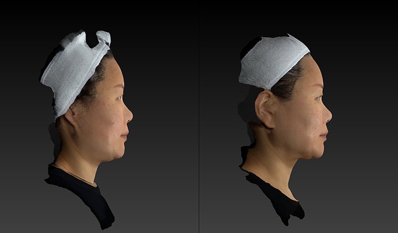 Renuvion Before & After Image