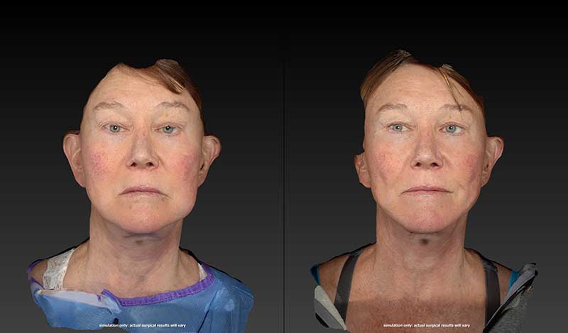 Renuvion Before & After Image