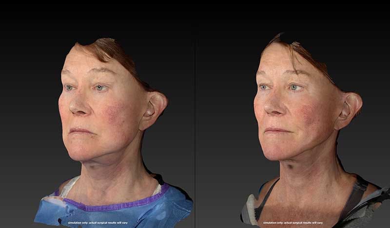 Renuvion Before & After Image