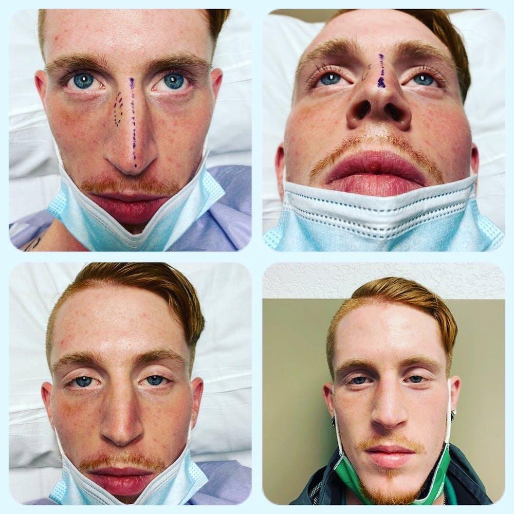 Rhinoplasty Before & After Image