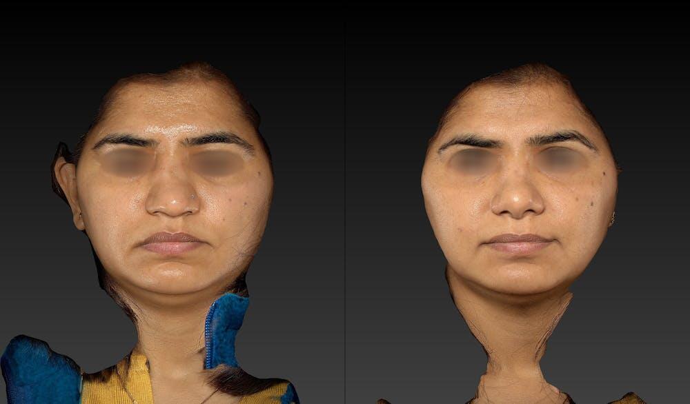 Rhinoplasty Before & After Image