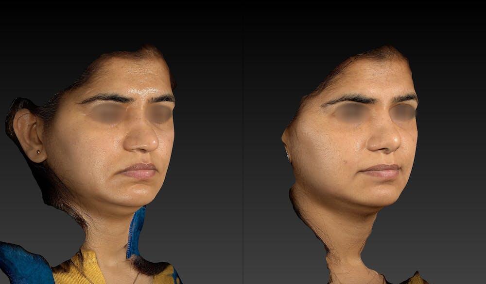 Rhinoplasty Before & After Image