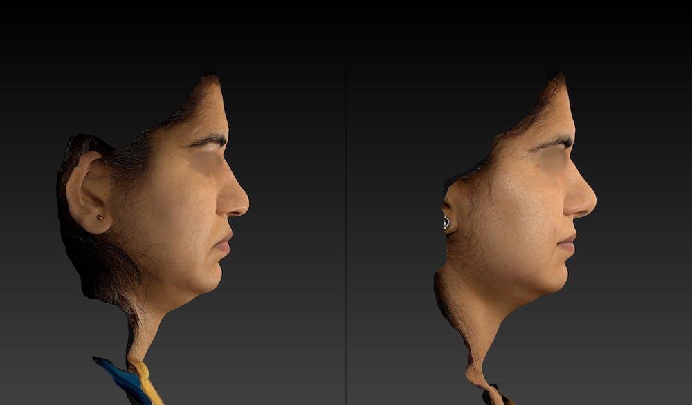 Rhinoplasty Before & After Image