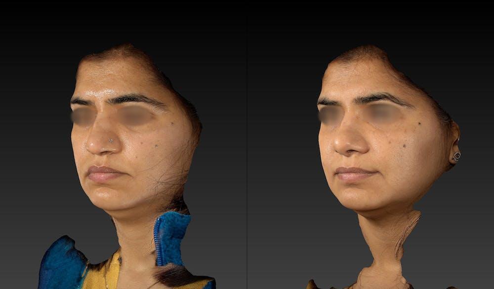 Rhinoplasty Before & After Image