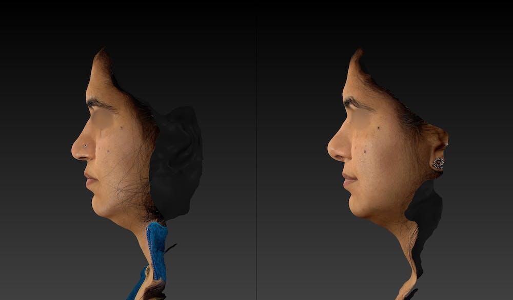 Rhinoplasty Before & After Image