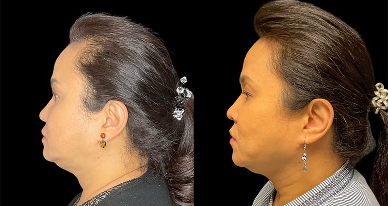 Rhinoplasty Before & After Image