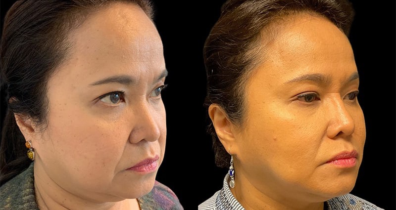 Rhinoplasty Before & After Image