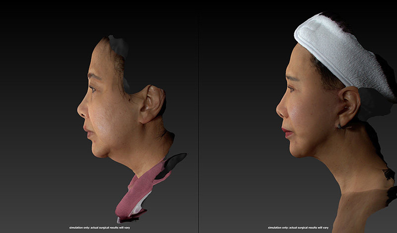 Rhinoplasty Before & After Image