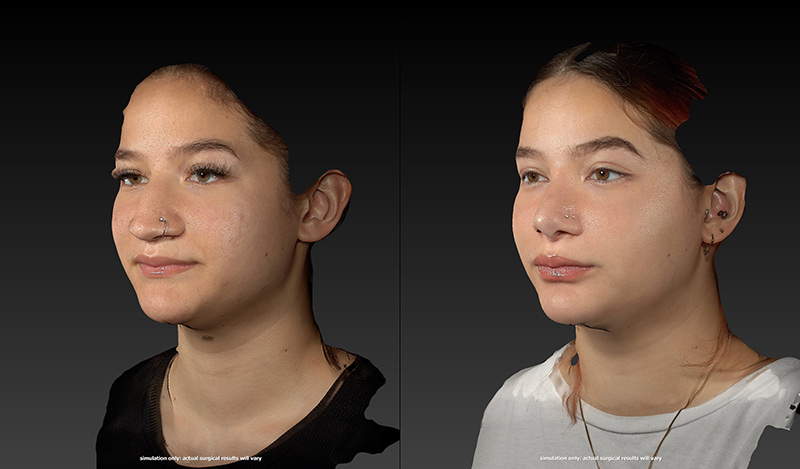 Rhinoplasty Before & After Image