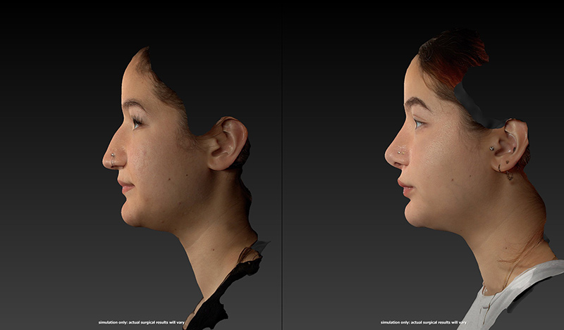 Rhinoplasty Before & After Image