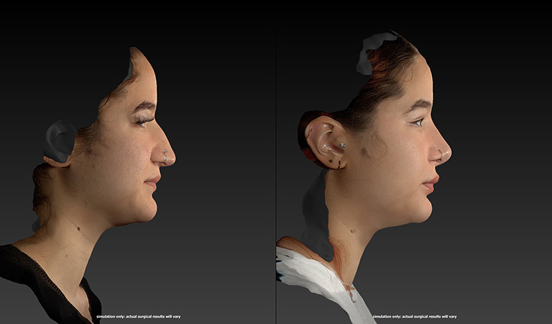 Rhinoplasty Before & After Image