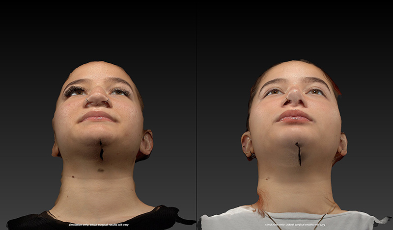 Rhinoplasty Before & After Image