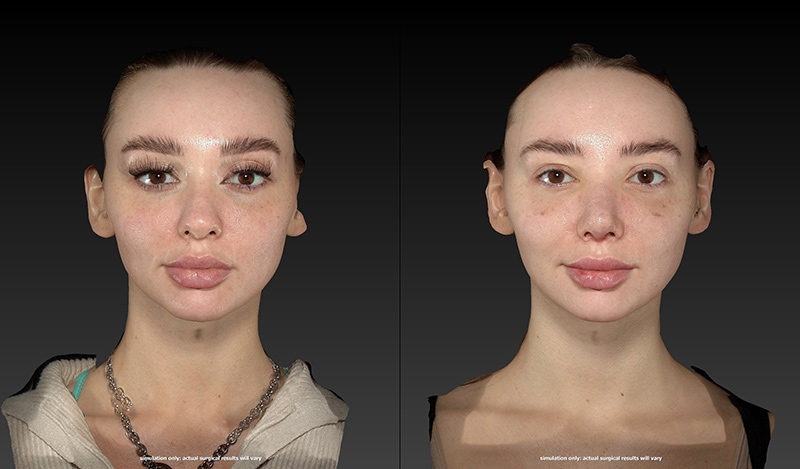 Rhinoplasty Before & After Image