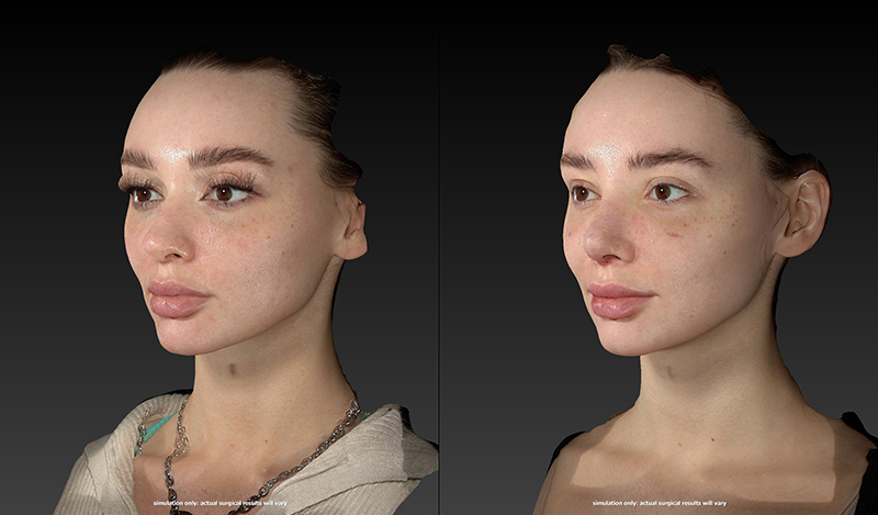 Rhinoplasty Before & After Image