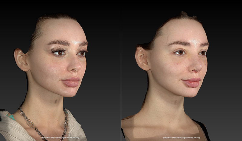 Rhinoplasty Before & After Image