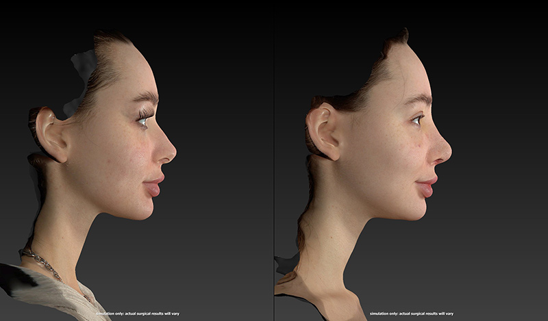 Rhinoplasty Before & After Image