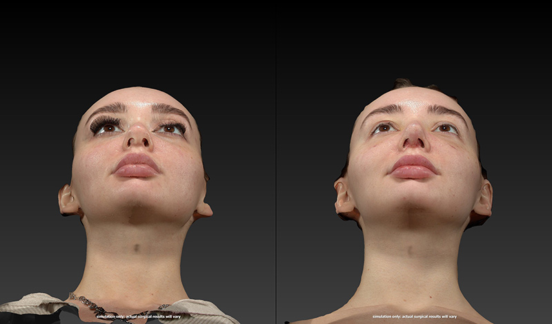 Rhinoplasty Before & After Image