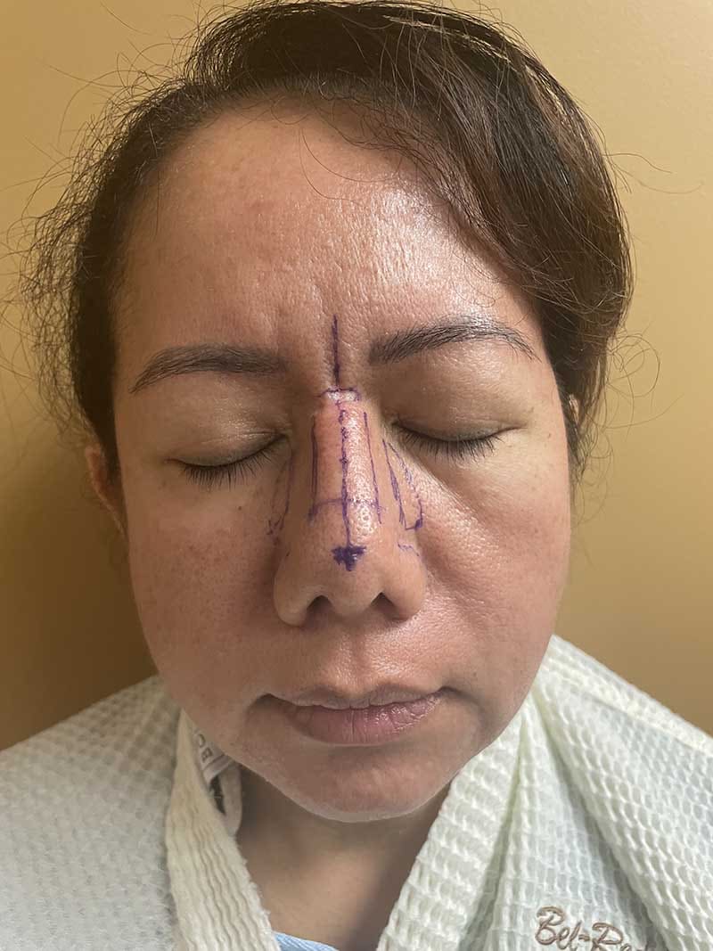 Rhinoplasty Before & After Image